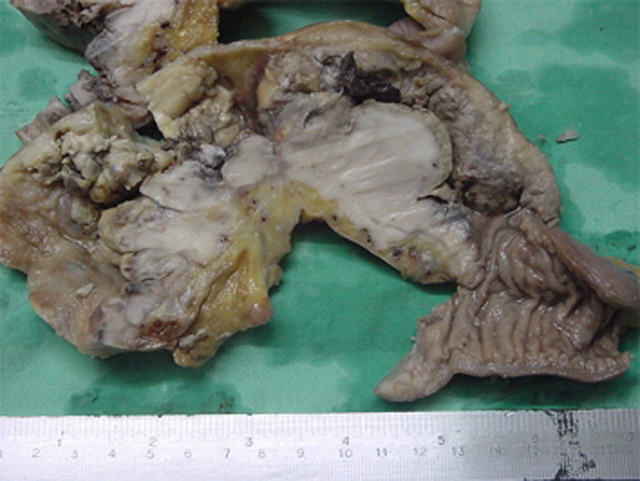 Fig. 6: IPSID. Pseudo-oclusión intestinal. - <div style=